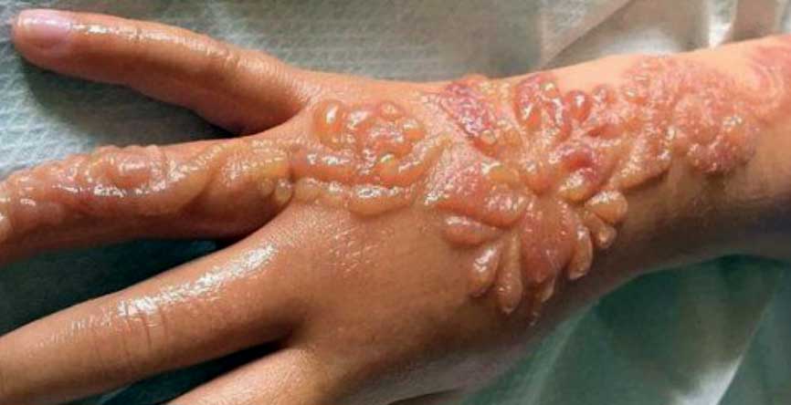 Cuidado con los tatuajes de henna negra!